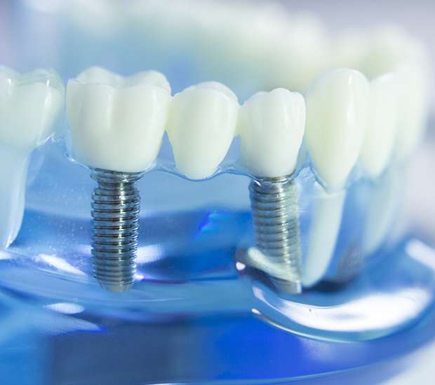 Shoreline Dental Implants